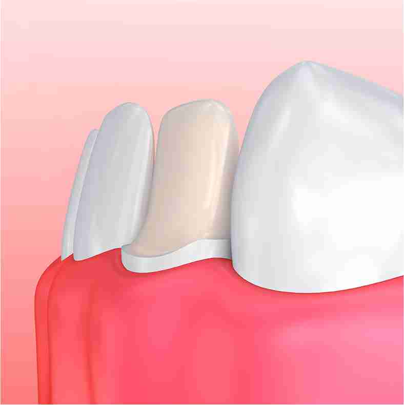Dra. Lucía Laborde - Carillas dentales - Preparación de los dientes