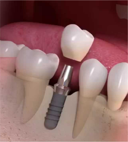 Dra. Lucía Laborde - Implantes dentales - Colocación de la prótesis