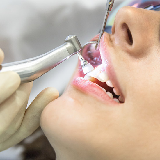 Dra. Lucía Laborde - Prevencion - ¿Cómo se limpian los dientes profesionalmente?